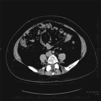 内臓脂肪型肥満